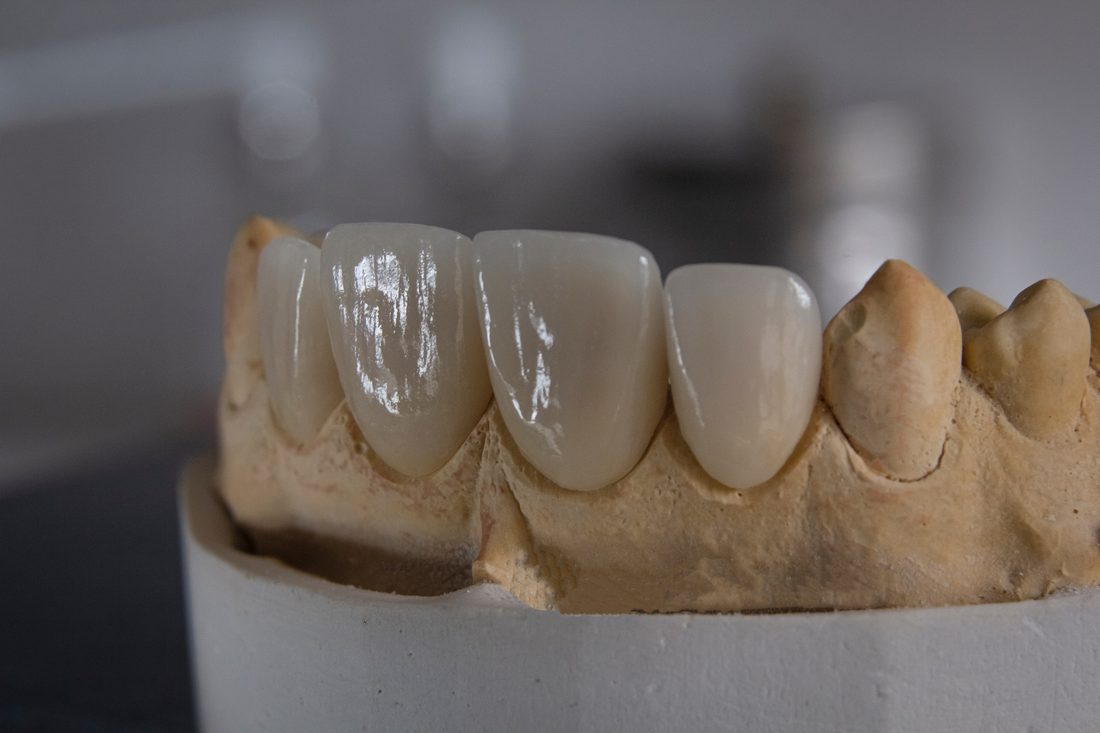A removable partial denture on a clinician's work surface.